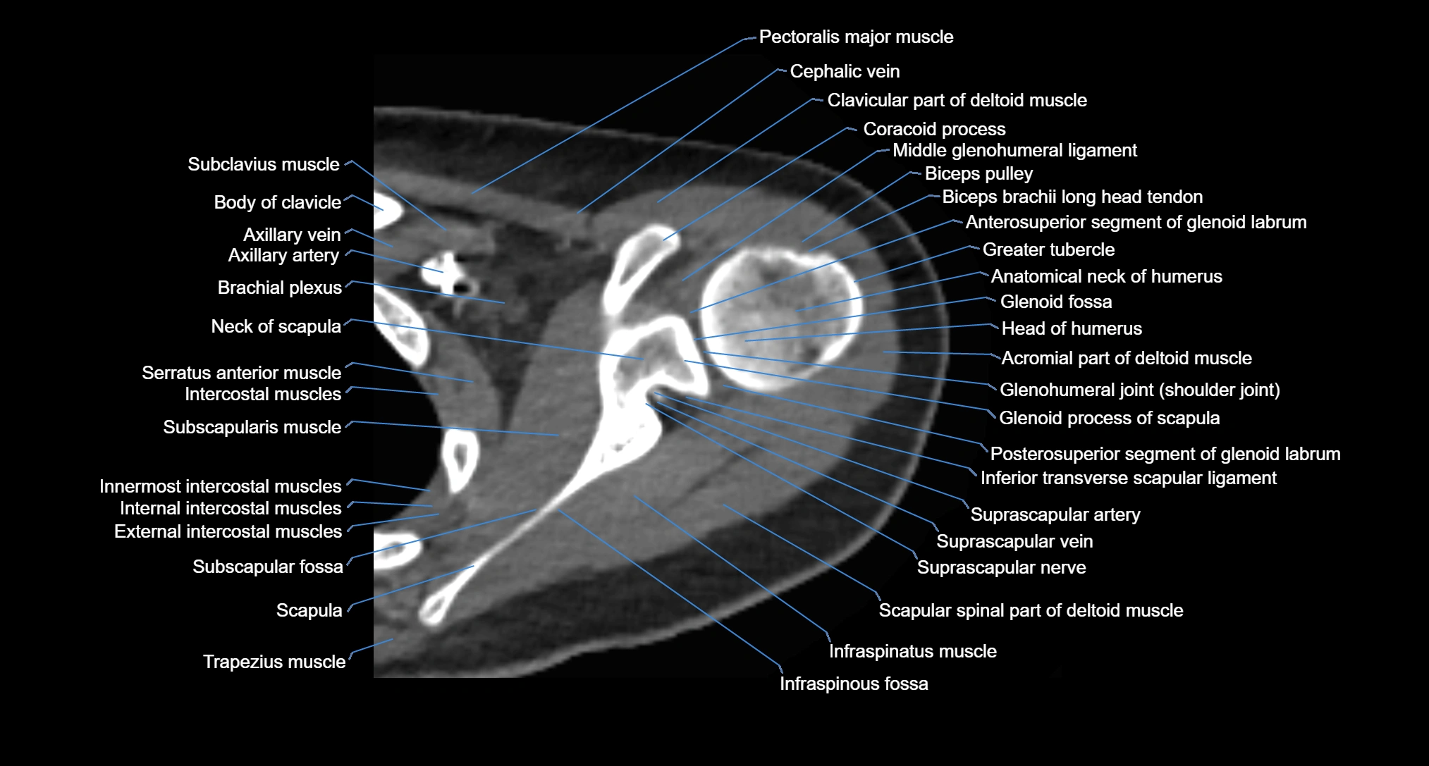 CT Shoulder axial cross sectional anatomy labelled radiology image -00027.webp